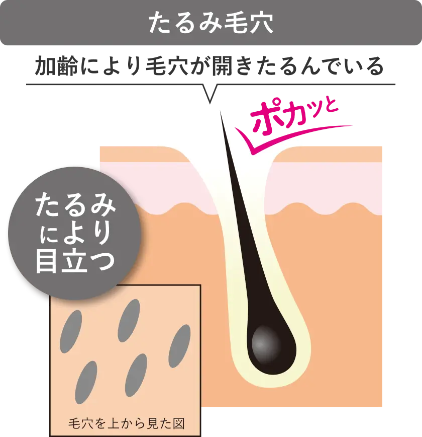 たるみ毛穴の肌図イメージ
