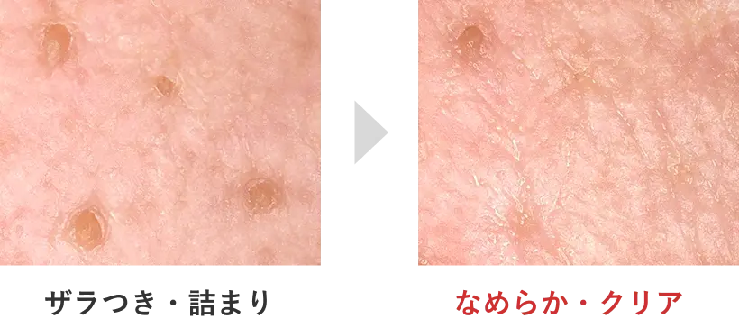 VC10の使用前と2週間使用後の肌状態