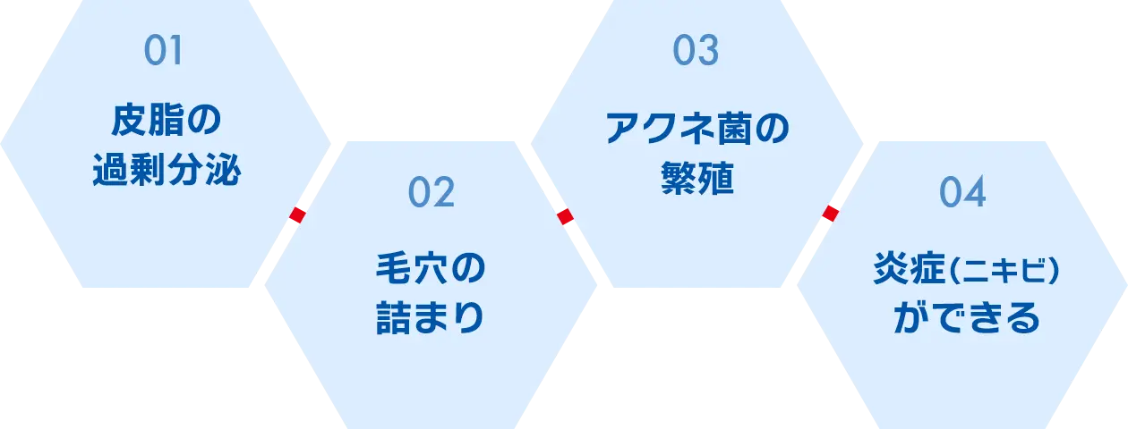 1.皮脂の 過剰分泌 |2.毛穴の 詰まり |3.アクネ菌の 繁殖 |4.炎症(ニキビ) ができる