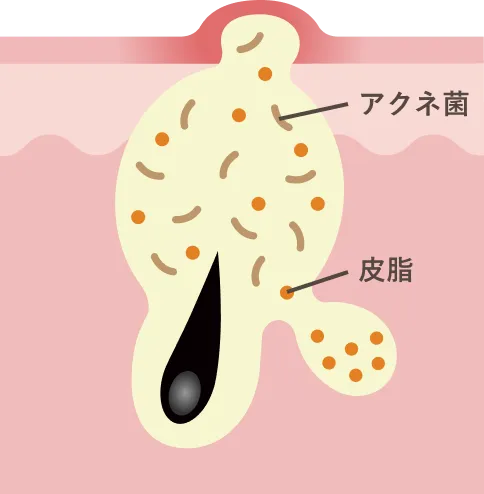 ニキビ肌
