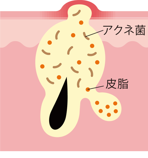 ニキビ肌