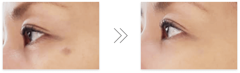 エッセンス薬用美白コンシーラーを塗る前の肌と塗った後の肌の比較